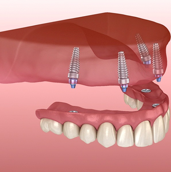 implant dentures 1 1 - Distinctive Dentistry
