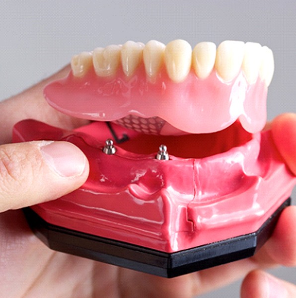 implant dentures 4 1 - Distinctive Dentistry