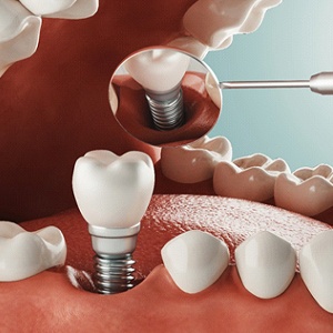 implant process 2 - Distinctive Dentistry
