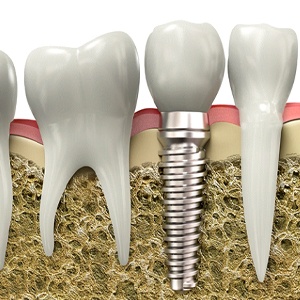 implant process 3 - Distinctive Dentistry