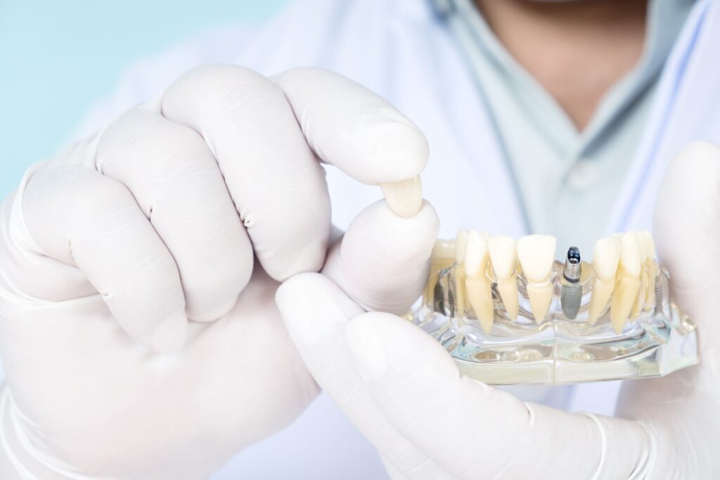 A dentist in white gloves holds a dental implant model, positioning a tooth implant.