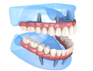 3D illustration of upper and lower dental implants in a transparent blue jaw model, showing gum structure and metal screws.