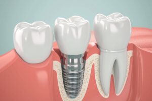 dental Implant