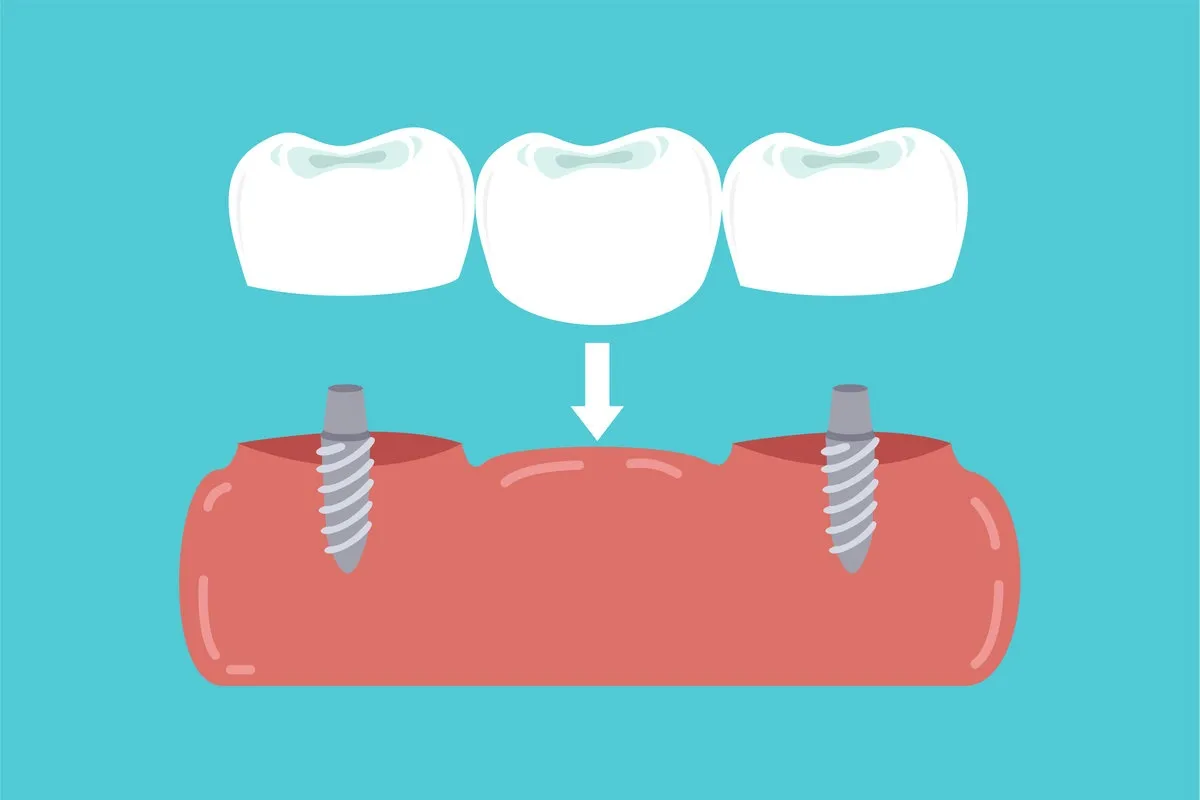 implants in gums supported dental bridge